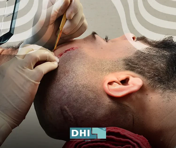 Benefits of laser after hair transplantation