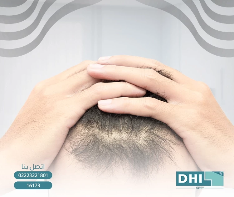 Everything you need to know about the cost and availability of hair plasma injections