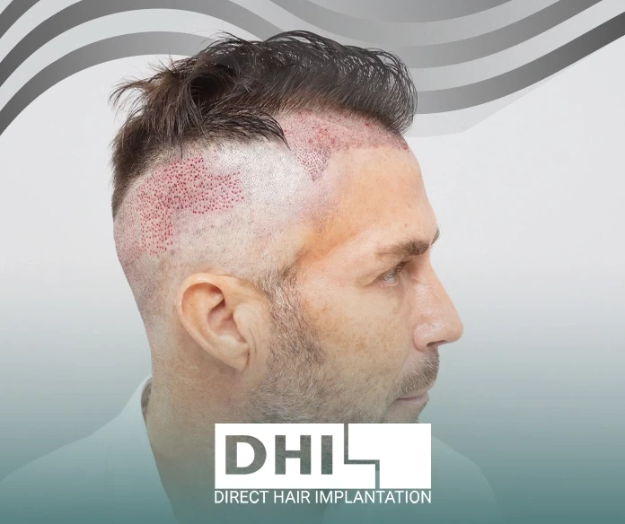 Harmful effects of laser hair transplantation
