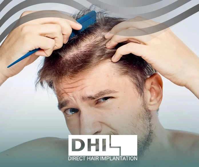 Causes of baldness in men