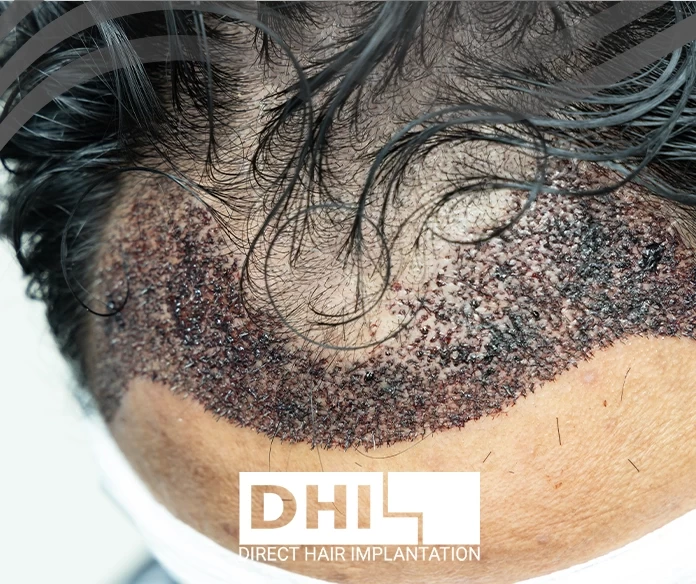 When does the transplanted hair appear?