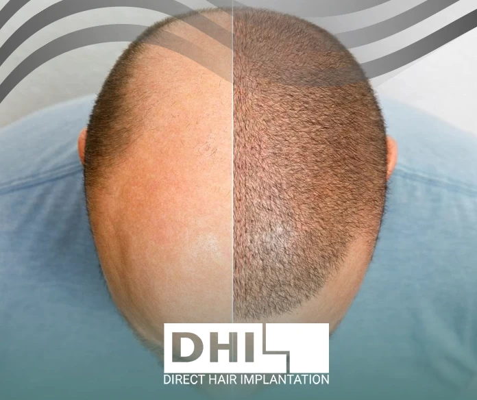 Is hair transplantation guaranteed?