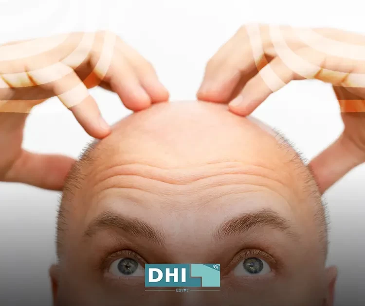 How to transplant hair in the forehead
