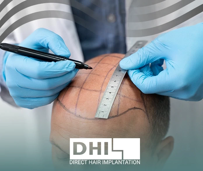 Harmful effects of hair transplantation