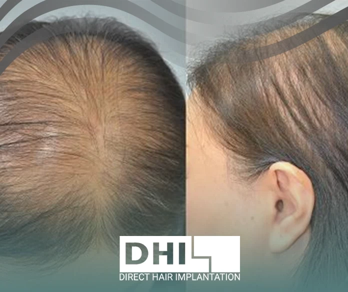 Signs of androgenetic alopecia