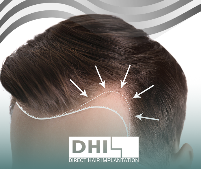 Treating hair gaps in the front of the head