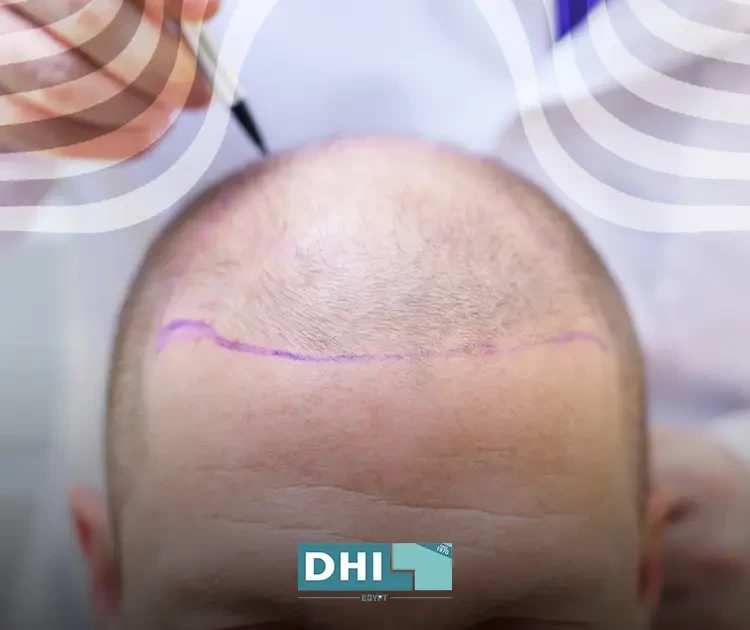 The most famous hair transplant doctor in Egypt