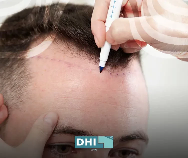 Transplanting hair from another person's follicles