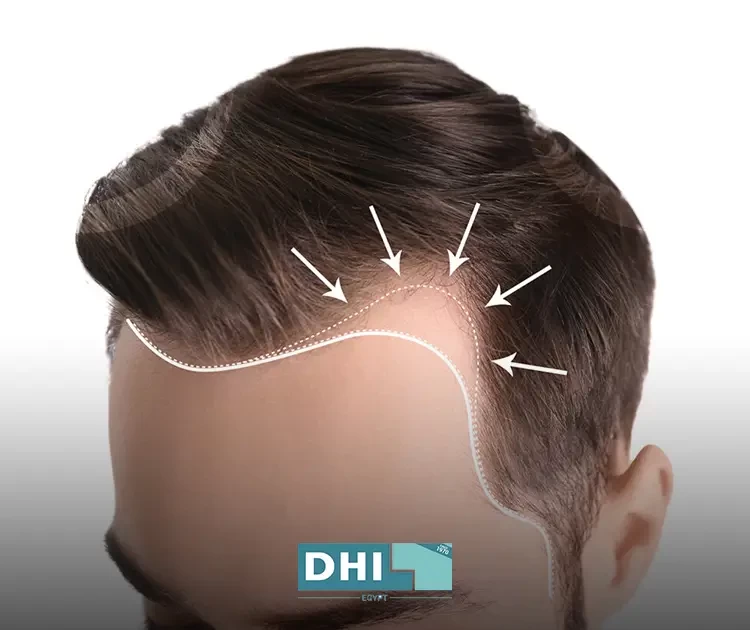 Frontal hair transplant for men