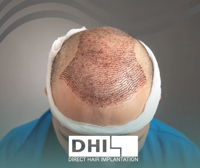 When can you be exposed to the sun after hair transplantation?