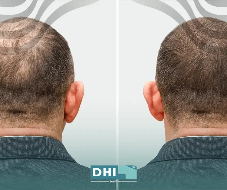 Hair implant vs transplant