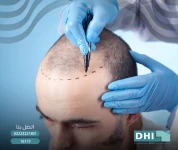 Direct hair transplantation